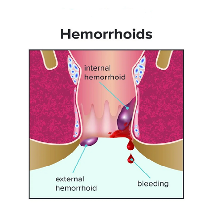 Hemorrhoidectomy